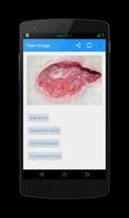 Wound Analysis